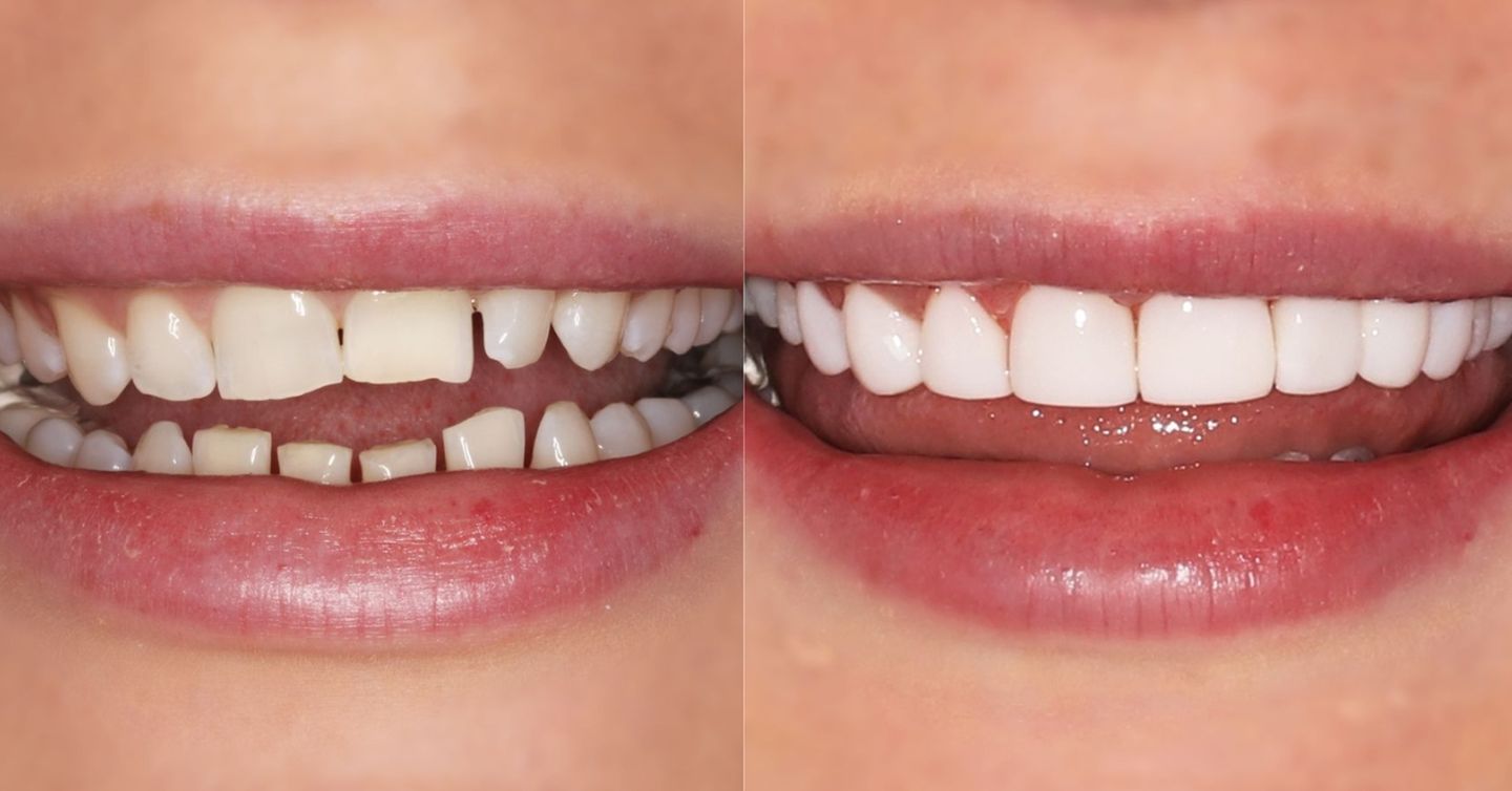 Composite bonding — Before / After