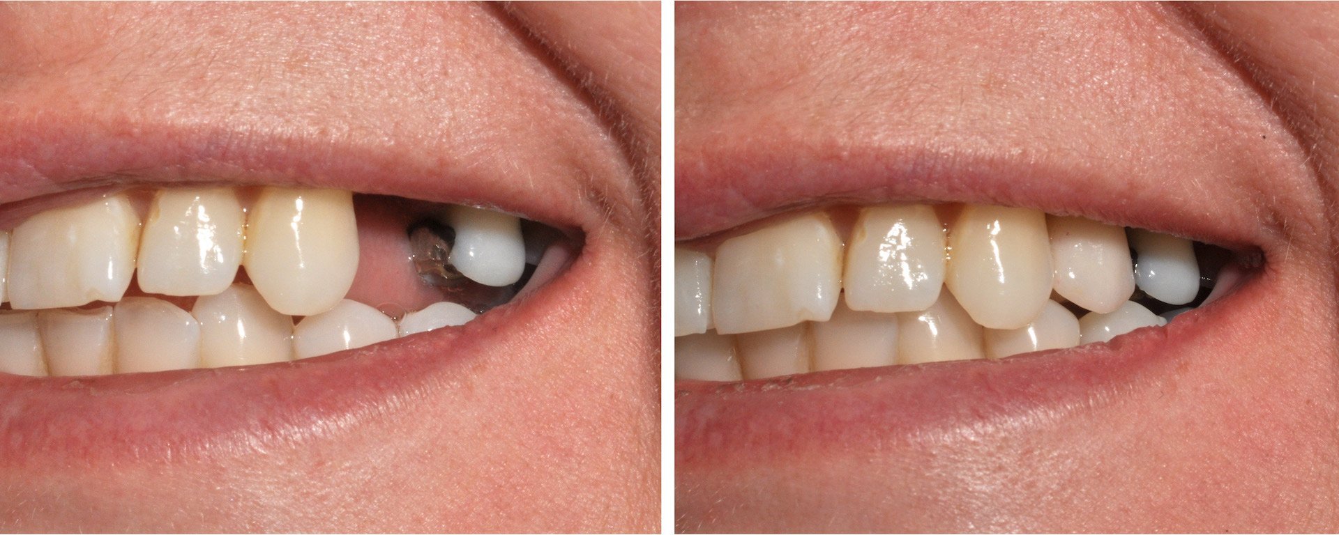 Single-tooth implant — Before / After