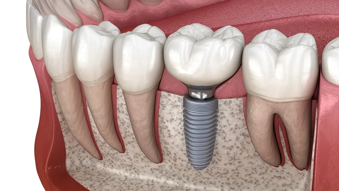 Implants at the practice