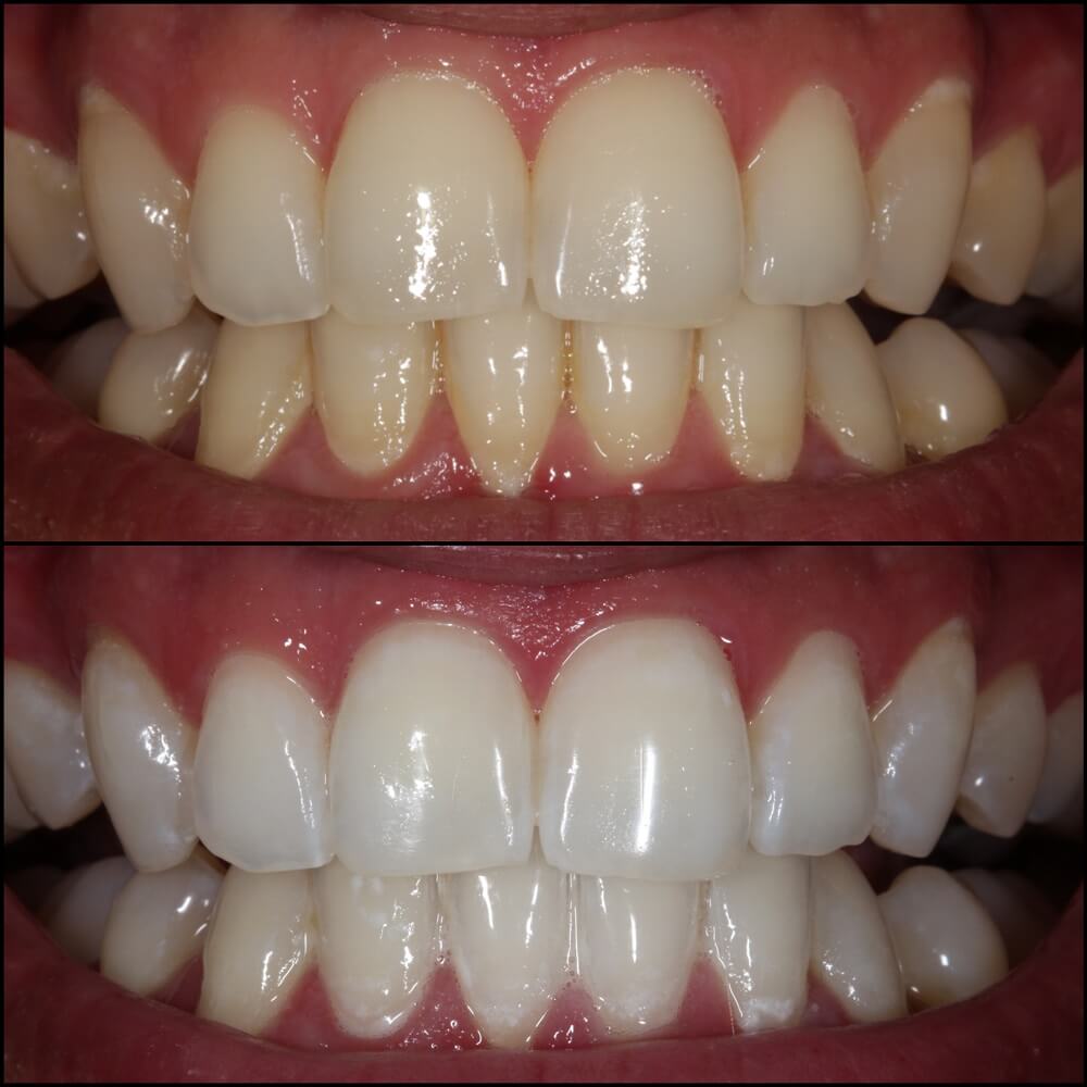 Whitening & hygiene — Before